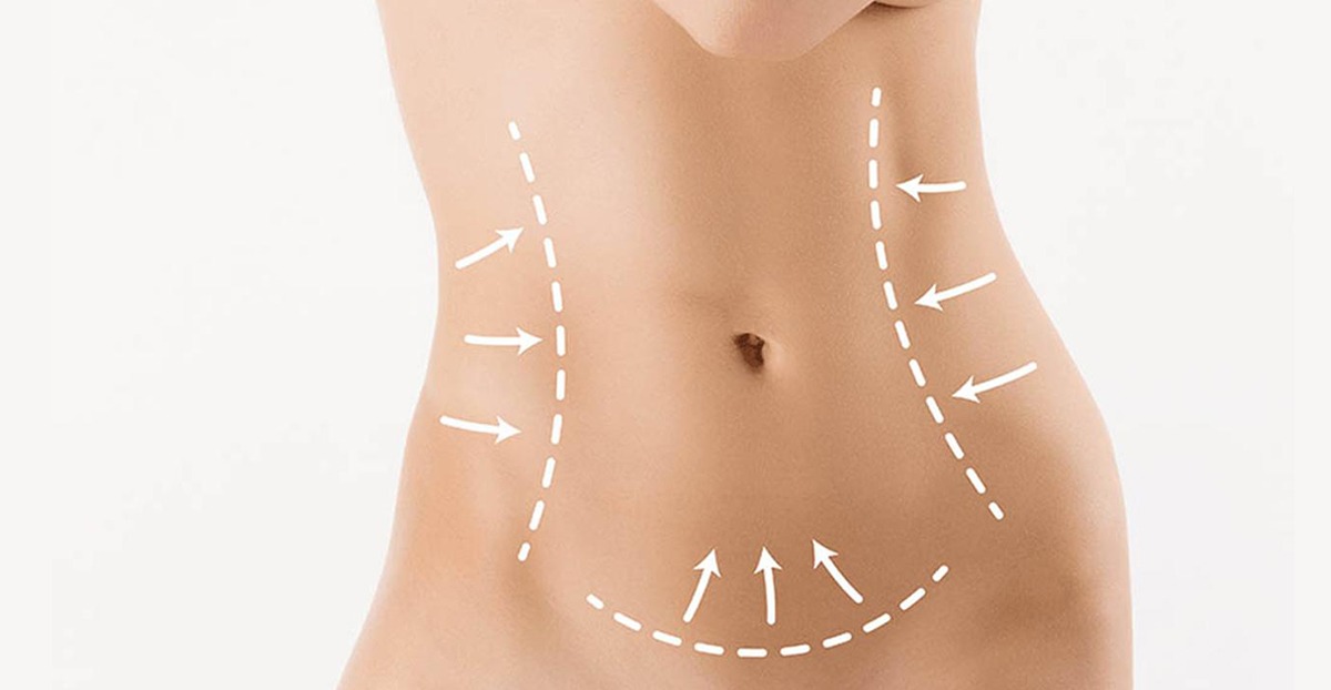 Plasties Abdominales